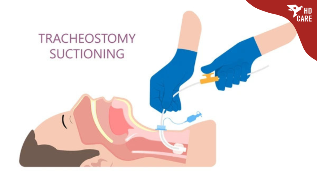 Máy hút đàm trong cổ họng bệnh nhân